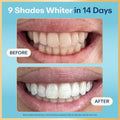Teeth Whitening Strips - 21 Treatments (3 Months) - Peroxide Free - Enamel Safe for Whiter Teeth - Whitening without the Sensitivity - Dentist Formulated - Sensitivity